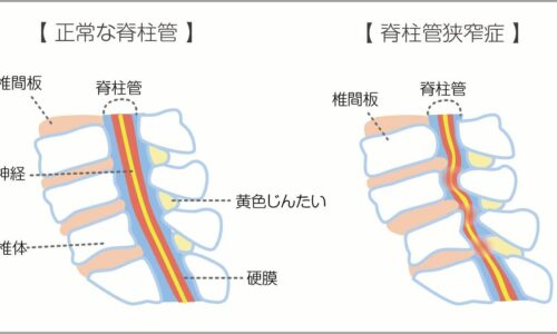 脊柱管狭窄症の患者さん